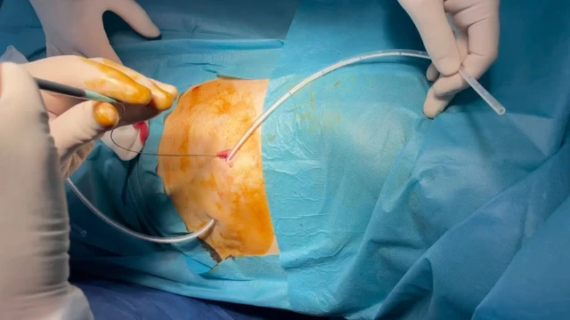 bai-viet/tim-hieu-chi-tiet-quy-trinh-ky-thuat-dan-luu-mang-phoi.html