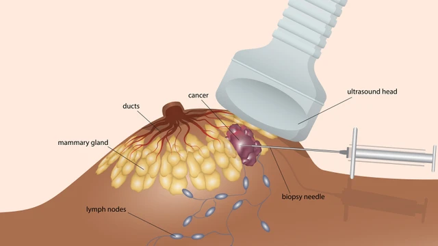 bai-viet/ky-thuat-hut-chan-khong-voi-may-vabb-trong-sinh-thiet-va-dieu-tri-u-tuyen-vu.html