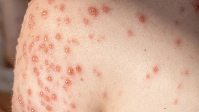 bai-viet/lam-gi-khi-thuy-dau-moc-qua-nhieu.html