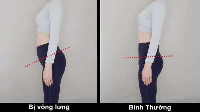 bai-viet/lam-sao-de-biet-minh-bi-vong-lung-luu-y-va-cach-dieu-tri-70072.html