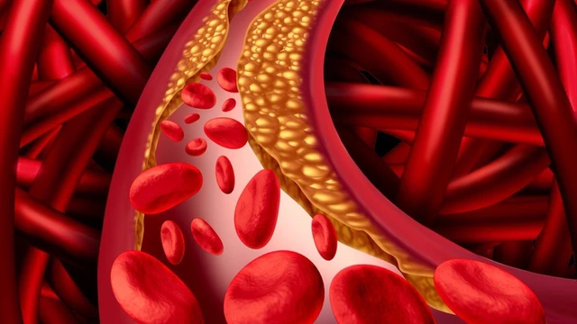 bai-viet/lao-hoa-mach-mau-la-gi-6-nguyen-tac-an-uong-tot-cho-tim-mach-va-de-phong-lao-hoa-52193.html