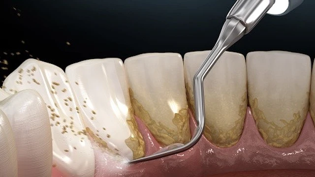 bai-viet/lay-cao-rang-het-bao-nhieu-tien-bao-lau-nen-lay-cao-rang-mot-lan.html