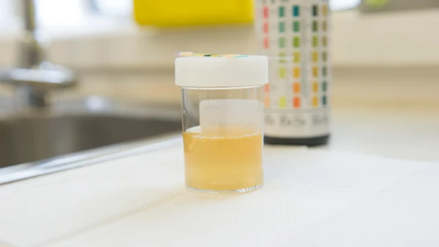 bai-viet/lay-nuoc-tieu-xet-nghiem-luc-nao-la-tot-nhat-phuong-phap-lay-nuoc-tieu-dung-cach.html