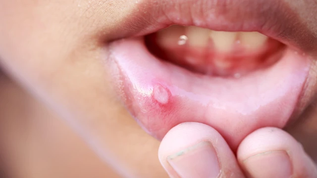 bai-viet/lo-mieng-o-moi-keo-dai-co-nguy-hiem-khong.html