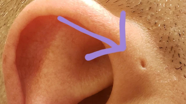 bai-viet/lo-o-tai-bam-sinh-la-benh-gi-co-nguy-hiem-khong.html