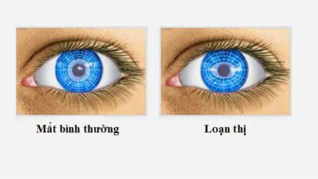 bai-viet/loan-thi-mot-ben-mat-la-gi-dieu-tri-nhu-the-nao.html