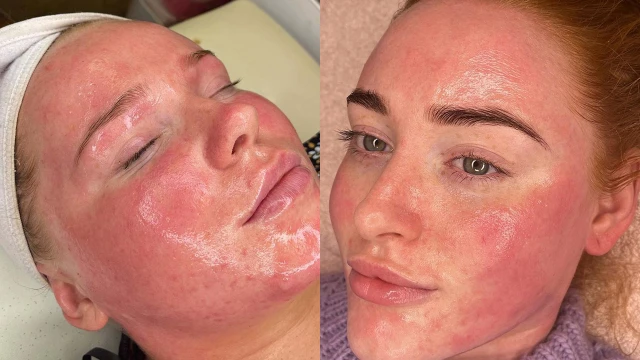 bai-viet/lot-da-xong-bi-do-rat-co-sao-khong-khac-phuc-nhu-the-nao.html