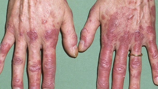 bai-viet/lupus-ban-do-co-may-loai-bien-chung-cua-lupus-ban-do-nguy-hiem-nhu-the-nao-56384.html