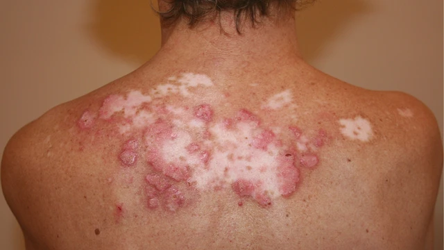 Hiểu về bệnh lupus ban đỏ dạng đĩa và cách phòng ngừa 2