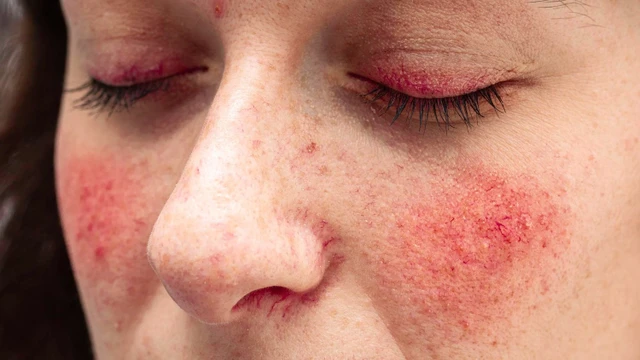 benh/lupus-ban-do-he-thong.html