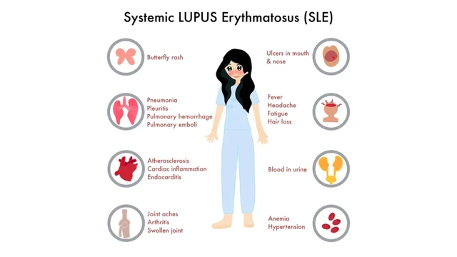 benh/lupus-ban-do-he-thong.html