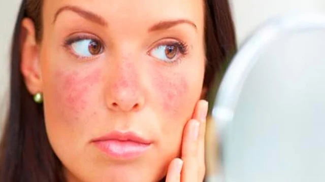 bai-viet/lupus-ban-do-man-tinh-nguyen-nhan-trieu-chung-va-cach-dieu-tri-57618.html