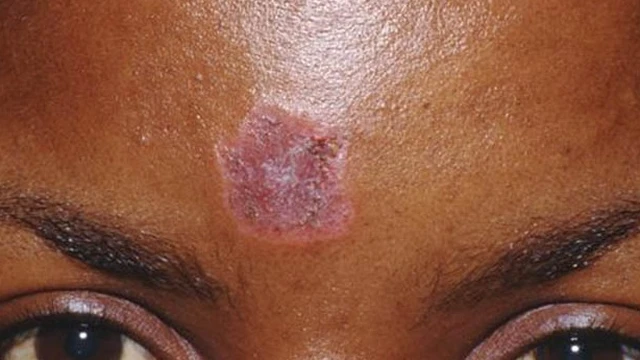 bai-viet/lupus-ban-do-o-mat-co-cac-dang-ton-thuong-nao-56414.html