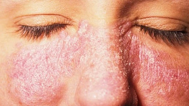 bai-viet/lupus-ban-do-tai-phat-co-the-dieu-tri-khoi-khong-56258.html