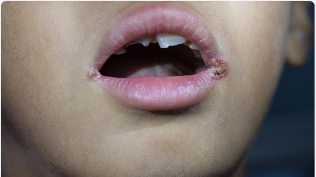 bai-viet/luu-ngay-nhung-dieu-can-biet-ve-viem-moi-nhiem-trung.html