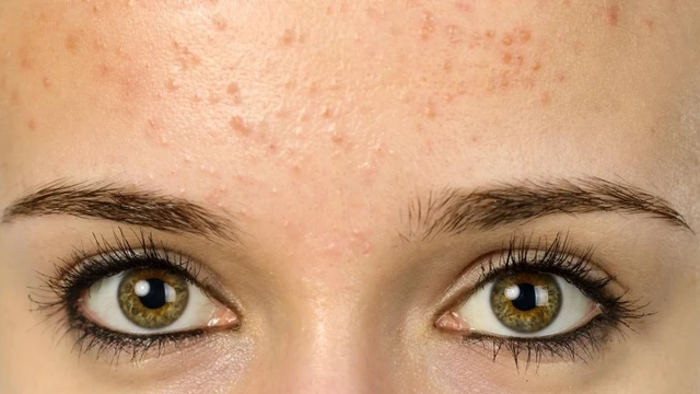 bai-viet/nguyen-nhan-xuat-hien-mun-noi-tiet-o-tran-ma-ban-can-biet.html