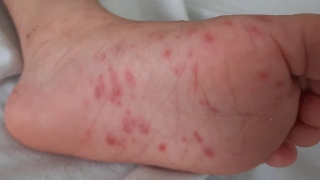 bai-viet/ma-icd-tay-chan-mieng-la-gi-va-nhung-thong-tin-can-biet-ve-ma-icd-tay-chan-mieng.html