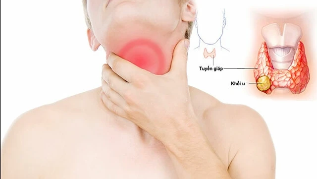 bai-viet/mac-benh-u-tuyen-giap-lanh-tinh-kieng-an-gi-nhung-luu-y-khi-bi-u-tuyen-giap-lanh-tinh.html