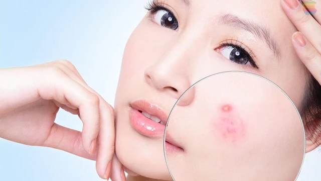 bai-viet/mach-ban-3-cach-tri-mun-viem-mu-don-gian-va-hieu-qua.html