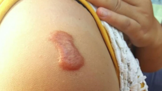 bai-viet/mach-ban-cach-khac-phuc-seo-loi-lan-rong-56332.html