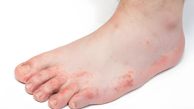 bai-viet/cach-phan-biet-benh-ghe-nuoc-va-to-dia-thong-qua-cac-trieu-chung.html