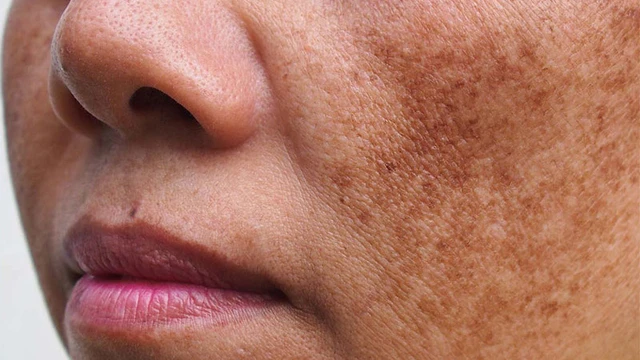 bai-viet/mach-ban-nhung-cach-tri-nam-hieu-qua-nhat-hien-nay.html