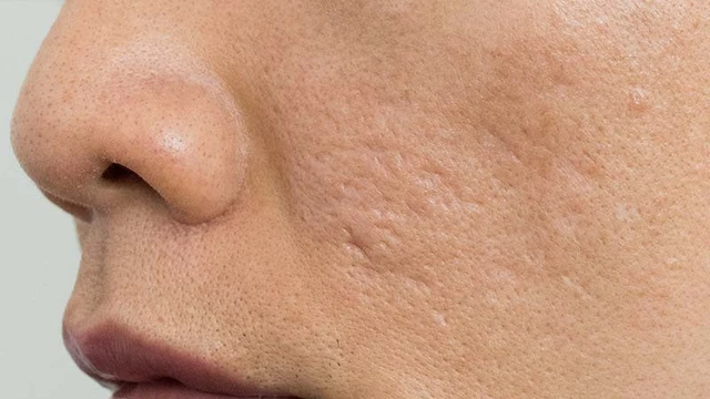 bai-viet/mach-ban-phuong-phap-tri-seo-ro-bang-nha-dam.html