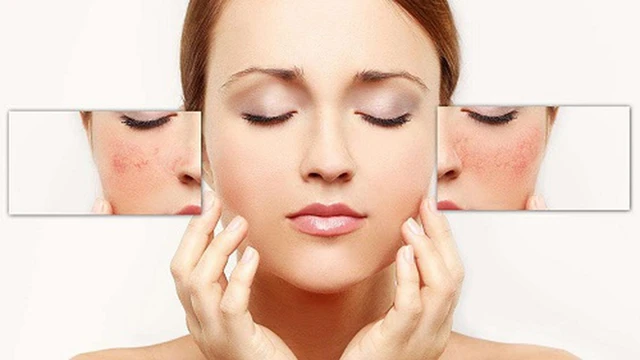 bai-viet/man-cam-la-gi-hoi-chung-man-cam-voi-thanh-phan-cua-thuoc-la-nhu-the-nao-68927.html