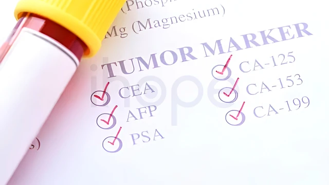 Marker ung thư dạ dày nói lên điều gì về sức khỏe của bạn?