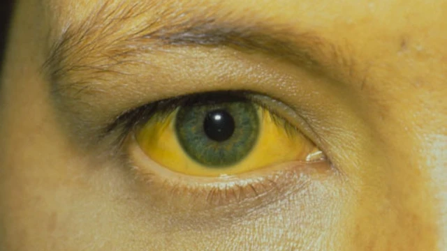 bai-viet/mat-vang-la-benh-gi-nguyen-nhan-dan-den-mat-vang.html