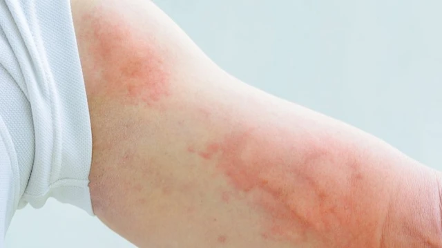 bai-viet/me-day-tu-phat-nguyen-nhan-va-cach-dieu-tri-hieu-qua-54251.html