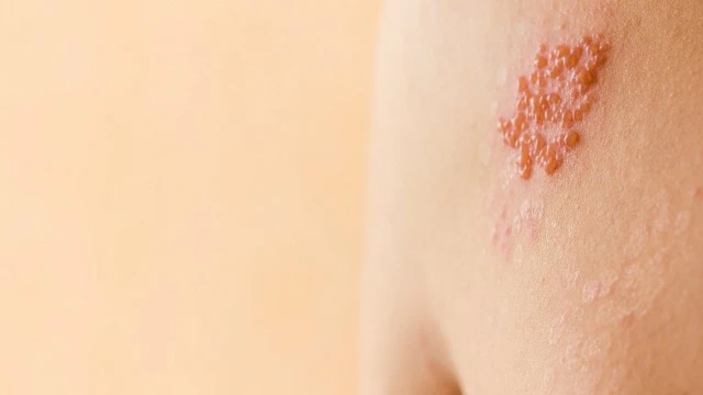 bai-viet/meo-tri-gioi-leo-bang-la-chuoi-co-hieu-qua-khong.html