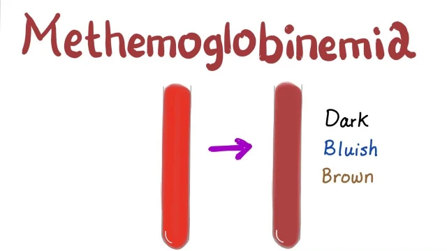 bai-viet/methemoglobin-la-gi-nguyen-nhan-va-cach-dieu-tri-benh.html