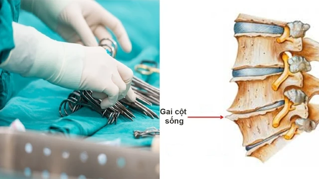 bai-viet/mo-gai-cot-song-het-bao-nhieu-tien-chi-phi-mo-doi-voi-tung-phuong-phap.html