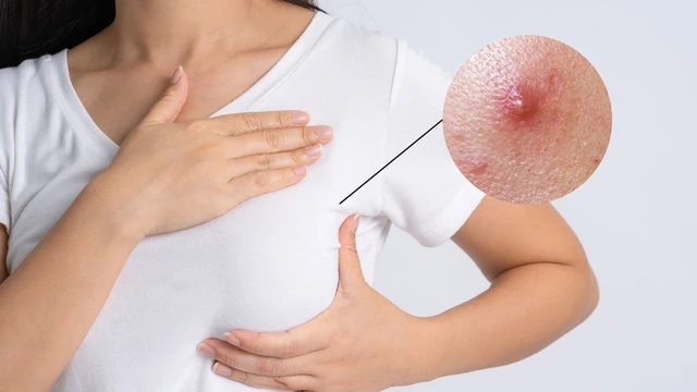 bai-viet/moc-mun-o-dau-ti-nguyen-nhan-va-cach-xu-tri-hieu-qua.html