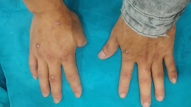 bai-viet/mom-cut-ngon-tay-la-gi-phuc-hoi-chuc-nang-mom-cut-ngon-tay-nhu-the-nao.html