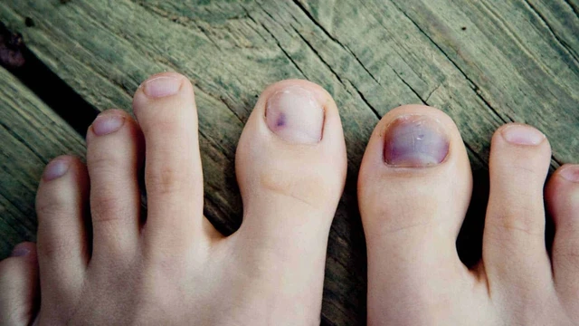 bai-viet/mong-chan-bi-den-bi-benh-gi-68012.html