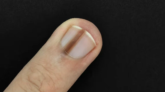 bai-viet/mong-chan-co-soc-den-nguyen-nhan-va-cach-dieu-tri.html