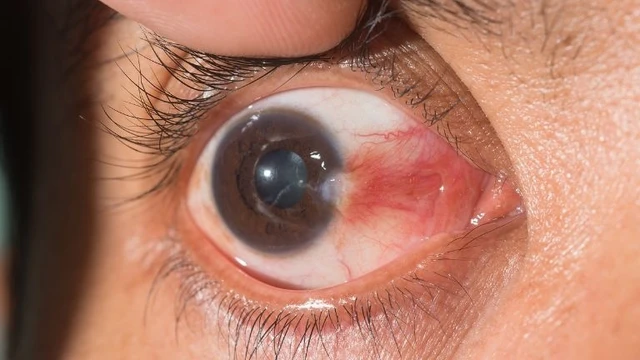 bai-viet/benh-mong-thit-o-mat-la-gi-co-dieu-tri-duoc-khong.html