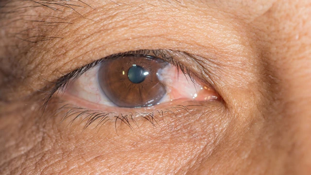 bai-viet/mong-mat-la-gi-nguyen-nhan-trieu-chung-va-cach-phong-ngua.html