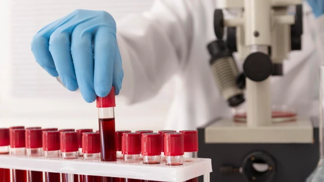 bai-viet/mono-trong-xet-nghiem-mau-la-gi-huong-dan-hieu-ket-qua.html