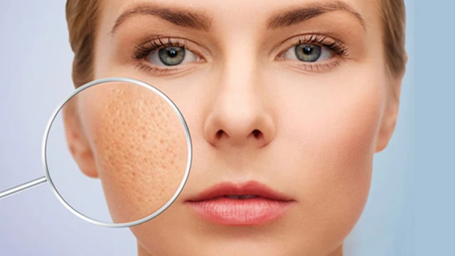 bai-viet/lieu-trinh-tri-seo-ro-bao-lau-thoi-gian-phuong-phap-va-cach-cham-soc-da-hieu-qua.html