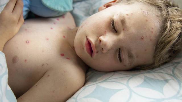 bai-viet/mot-so-bien-chung-cua-benh-thuy-dau-va-cach-phong-benh-hieu-qua.html