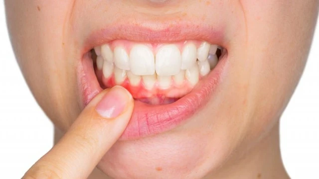 bai-viet/mot-so-cach-dieu-tri-viem-mo-te-bao-rang-57681.html