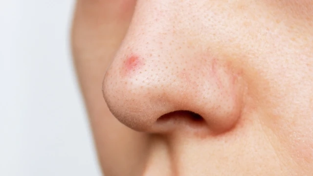 bai-viet/mot-so-cach-tri-mun-boc-o-mui-hieu-qua-nhanh-chong.html