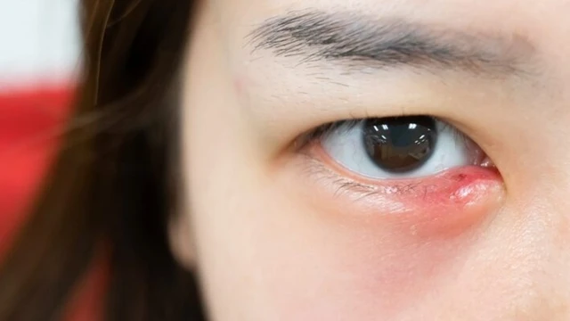 bai-viet/dau-hieu-bi-leo-mat-nhan-biet-som-de-dieu-tri-kip-thoi.html