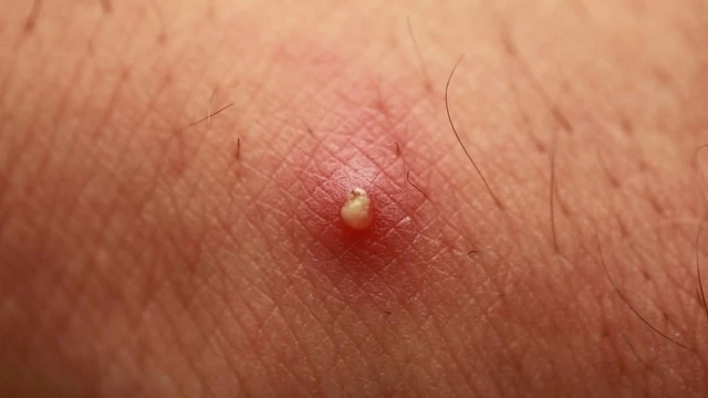 bai-viet/mu-la-gi-nguyen-nhan-va-trieu-chung-cua-tinh-trang-mung-mu.html