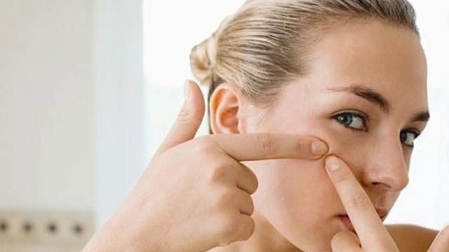 bai-viet/mun-an-co-nen-nan-khong-khi-nao-nen-lay-nhan-mun-an.html