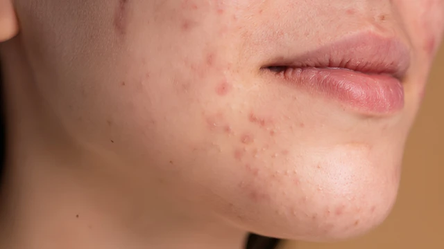bai-viet/mun-an-nen-dung-bha-hay-retinol-de-cai-thien-lan-da-luu-y-khi-su-dung.html
