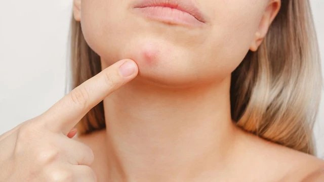 bai-viet/mun-boc-la-mun-nhu-the-nao-cac-dau-hieu-nhan-biet-mun-boc.html